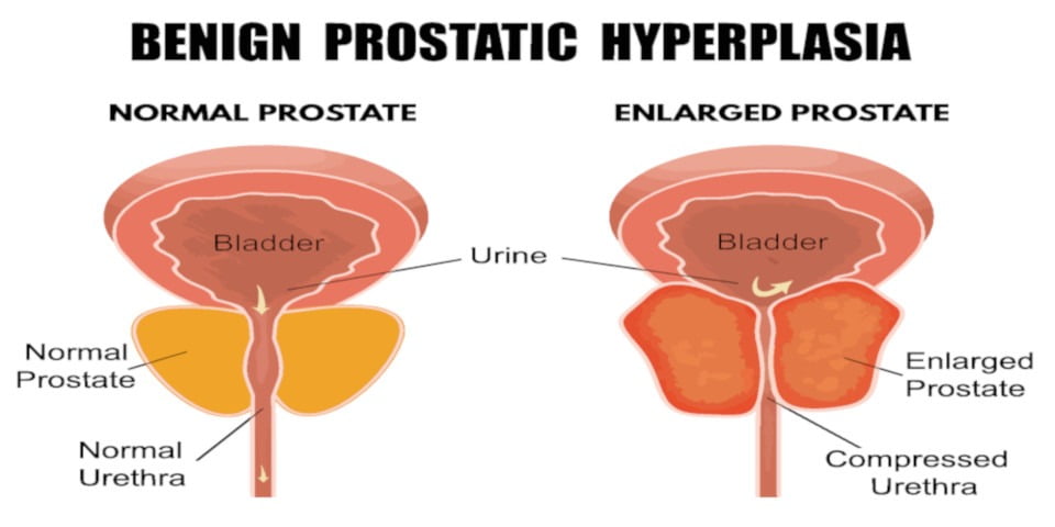 What does having an enlarged prostate mean