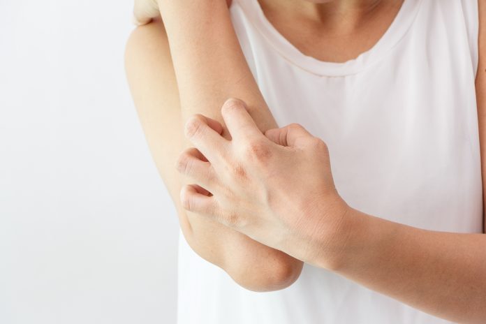 Winter or summer, which is worse for eczema?