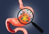 Common stomach bug linked to 1 in 5 bowel cancer cases, study suggests